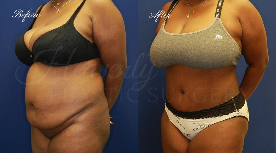 Plastic Surgery, Plastic Surgeon, Tummy Tuck, Abdominoplasty, Tummy Tuck with Lipo, Liposuction, Orange County Plastic Surgeon, Orange County Plastic Surgery, Fupa, Fupa surgery, fupa surgeon