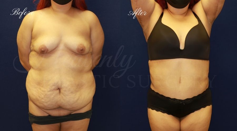 Plastic Surgery, Plastic Surgeon, Tummy Tuck, Abdominoplasty, Tummy Tuck with Lipo, Liposuction, Orange County Plastic Surgeon, Orange County Plastic Surgery, Fupa, Fupa surgery, fupa surgeon