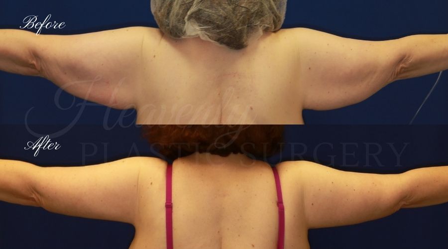 Plastic Surgery, Liposuction, Arm Lift, Brachioplasty, arms, bat wings Plastic Surgery, Liposuction, Arm Lift, Brachioplasty, arms, bat wings