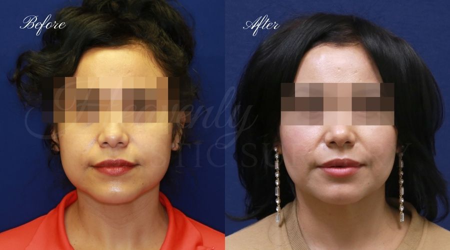 buccal fat pad removal, buccal fat removal, buccal fat pad removal orange county, buccal fat surgeon, buccal fat surgery, cheek fat removal, cheek fat surgery, cheek fat surgeon, cheek surgery before and after, buccal fat pad removal before and after, buccal fat before and after, facelift, face lift, neck lift buccal fat pad removal, buccal fat removal, buccal fat pad removal orange county, buccal fat surgeon, buccal fat surgery, cheek fat removal, cheek fat surgery, cheek fat surgeon, cheek surgery before and after, buccal fat pad removal before and after, buccal fat before and after, facelift, face lift, neck lift