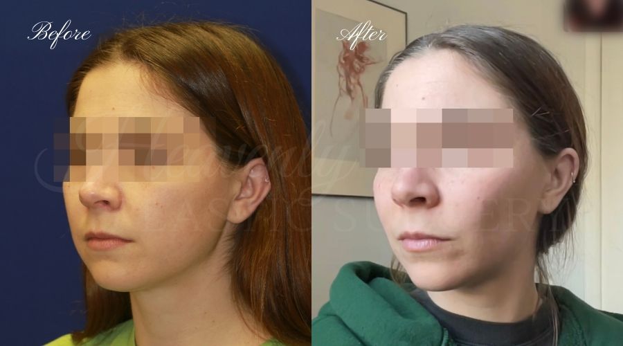 buccal fat pad removal, buccal fat removal, buccal fat pad removal orange county, buccal fat surgeon, buccal fat surgery, cheek fat removal, cheek fat surgery, cheek fat surgeon, cheek surgery before and after, buccal fat pad removal before and after, buccal fat before and after