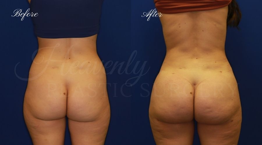 BBL Orange county, brazilian butt lift orange county, brazilian butt lift before and after, brazilian butt lift surgeon, brazilian butt lift results, bbl surgeon, bbl results, bbl before and after, fat transfer to the butt, butt augmentation, butt augmentation surgery, butt augmentation surgeon