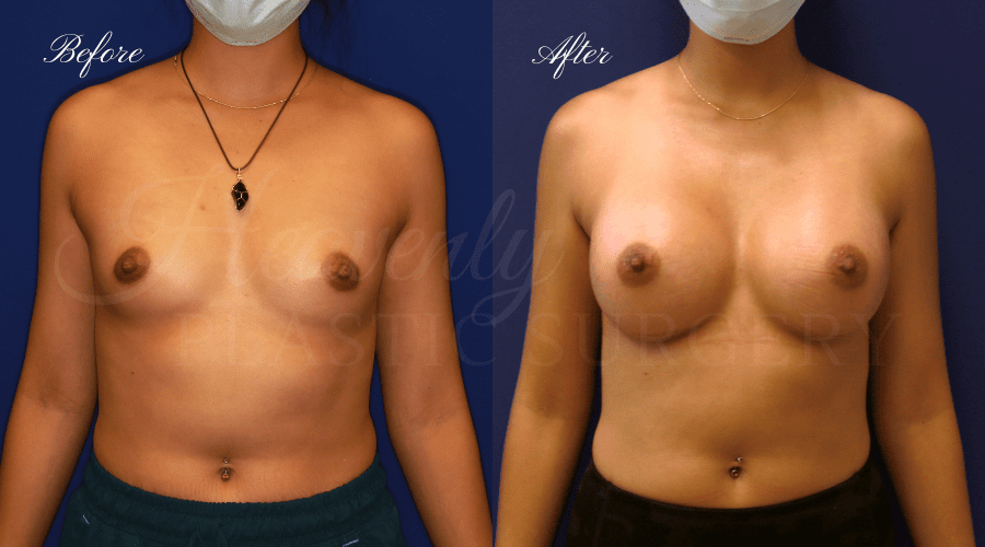 breast augmentation, breast augmentation surgery, breast augmentation surgeon, breast augmentation orange county, breast augmentation with silicone implants, sientra implants, boob job, boob job surgeon, breast implant surgeon, plastic surgery orange county, lake forest plastic surgeon, breast augmentation lake forest, south oc plastic surgeon