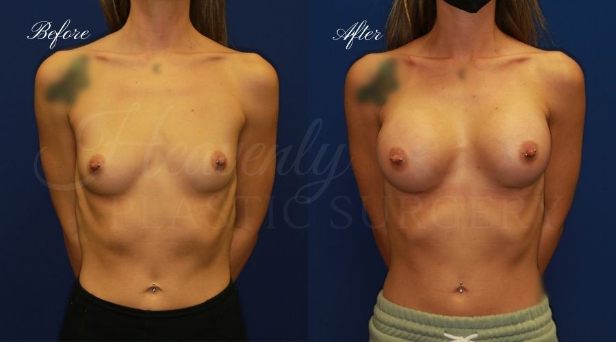 breast augmentation, breast augmentation surgery, breast augmentation surgeon, breast augmentation orange county, breast augmentation with silicone implants, sientra implants, boob job, boob job surgeon, breast implant surgeon, plastic surgery orange county, lake forest plastic surgeon, breast augmentation lake forest, south oc plastic surgeon