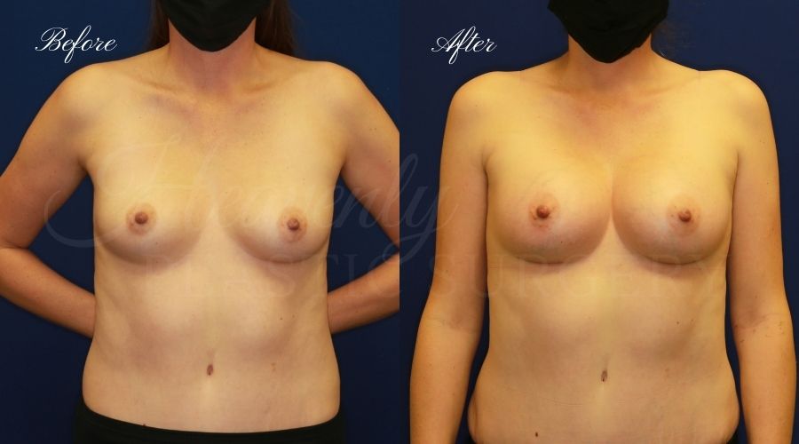 breast augmentation, breast augmentation surgery, breast augmentation surgeon, breast augmentation orange county, breast augmentation with silicone implants, sientra implants, boob job, boob job surgeon, breast implant surgeon, plastic surgery orange county, lake forest plastic surgeon, breast augmentation lake forest, south oc plastic surgeon