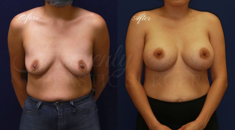 breast augmentation, breast augmentation surgery, breast augmentation surgeon, breast augmentation orange county, breast augmentation with silicone implants, sientra implants, boob job, boob job surgeon, breast implant surgeon, plastic surgery orange county, lake forest plastic surgeon, breast augmentation lake forest, south oc plastic surgeon breast augmentation, breast augmentation surgery, breast augmentation surgeon, breast augmentation orange county, breast augmentation with silicone implants, sientra implants, boob job, boob job surgeon, breast implant surgeon, plastic surgery orange county, lake forest plastic surgeon, breast augmentation lake forest, south oc plastic surgeon