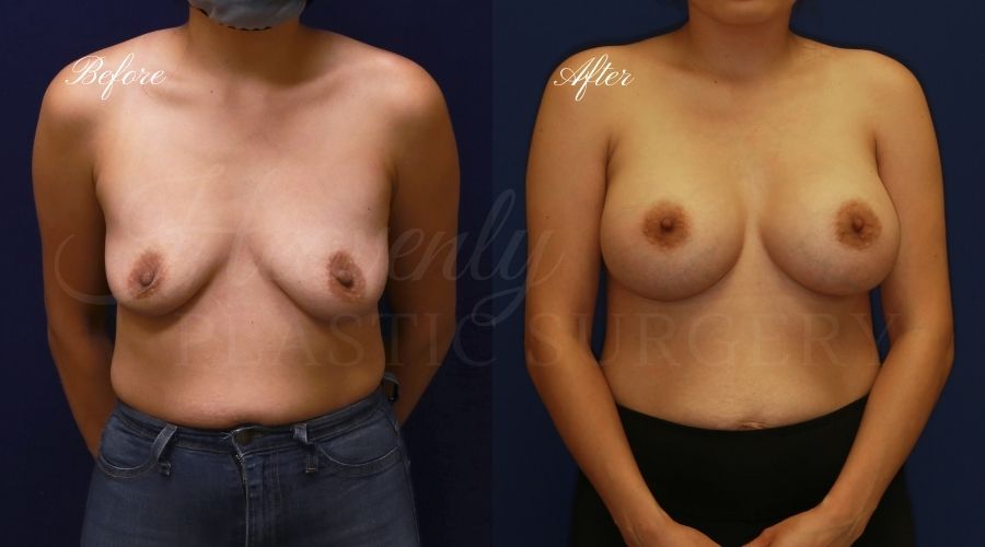 breast augmentation, breast augmentation surgery, breast augmentation surgeon, breast augmentation orange county, breast augmentation with silicone implants, sientra implants, boob job, boob job surgeon, breast implant surgeon, plastic surgery orange county, lake forest plastic surgeon, breast augmentation lake forest, south oc plastic surgeon