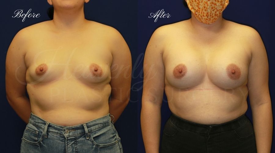 breast augmentation, breast augmentation surgery, breast augmentation surgeon, breast augmentation orange county, breast augmentation with silicone implants, sientra implants, boob job, boob job surgeon, breast implant surgeon, plastic surgery orange county, lake forest plastic surgeon, breast augmentation lake forest, south oc plastic surgeon