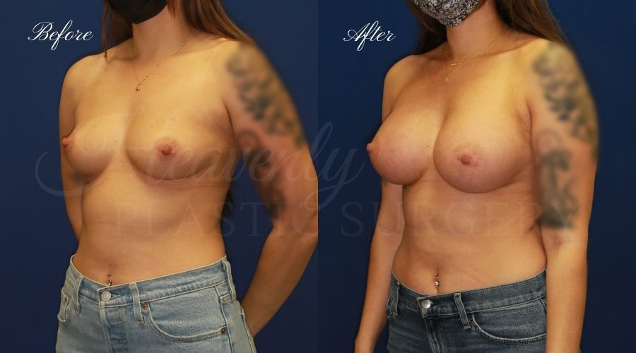 breast augmentation, breast augmentation surgery, breast augmentation surgeon, breast augmentation orange county, breast augmentation with silicone implants, sientra implants, boob job, boob job surgeon, breast implant surgeon, plastic surgery orange county, lake forest plastic surgeon, breast augmentation lake forest, south oc plastic surgeon breast augmentation, breast augmentation surgery, breast augmentation surgeon, breast augmentation orange county, breast augmentation with silicone implants, sientra implants, boob job, boob job surgeon, breast implant surgeon, plastic surgery orange county, lake forest plastic surgeon, breast augmentation lake forest, south oc plastic surgeon