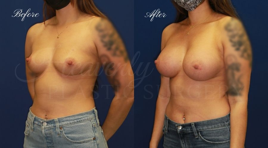 breast augmentation, breast augmentation surgery, breast augmentation surgeon, breast augmentation orange county, breast augmentation with silicone implants, sientra implants, boob job, boob job surgeon, breast implant surgeon, plastic surgery orange county, lake forest plastic surgeon, breast augmentation lake forest, south oc plastic surgeon