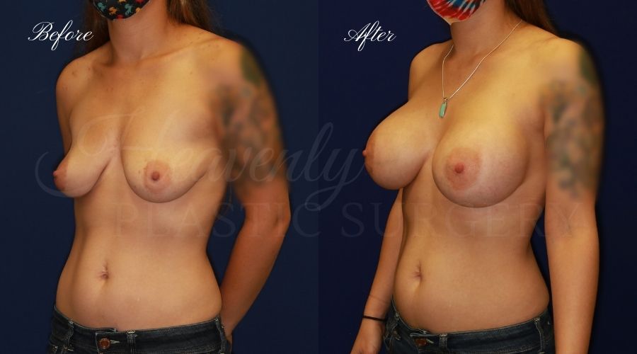 breast augmentation, breast augmentation surgery, breast augmentation surgeon, breast augmentation orange county, breast augmentation with silicone implants, sientra implants, boob job, boob job surgeon, breast implant surgeon, plastic surgery orange county, lake forest plastic surgeon, breast augmentation lake forest, south oc plastic surgeon breast augmentation, breast augmentation surgery, breast augmentation surgeon, breast augmentation orange county, breast augmentation with silicone implants, sientra implants, boob job, boob job surgeon, breast implant surgeon, plastic surgery orange county, lake forest plastic surgeon, breast augmentation lake forest, south oc plastic surgeon
