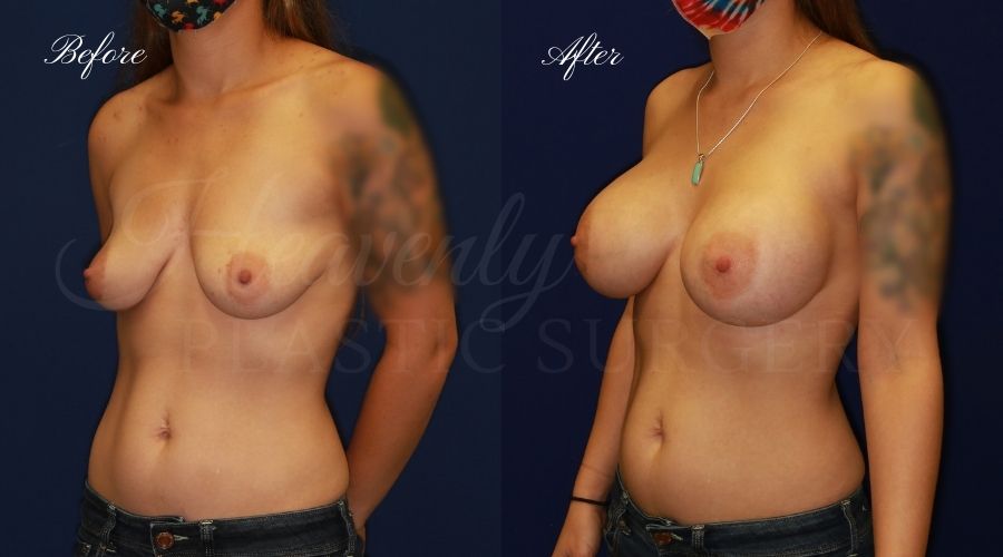 breast augmentation, breast augmentation surgery, breast augmentation surgeon, breast augmentation orange county, breast augmentation with silicone implants, sientra implants, boob job, boob job surgeon, breast implant surgeon, plastic surgery orange county, lake forest plastic surgeon, breast augmentation lake forest, south oc plastic surgeon