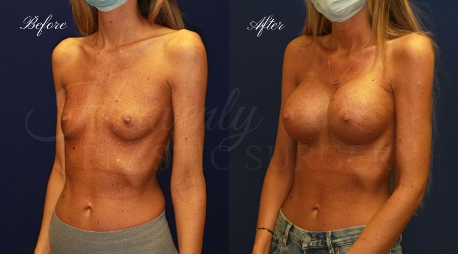 breast augmentation, breast augmentation surgery, breast augmentation surgeon, breast augmentation orange county, breast augmentation with silicone implants, sientra implants, boob job, boob job surgeon, breast implant surgeon, plastic surgery orange county, lake forest plastic surgeon, breast augmentation lake forest, south oc plastic surgeon