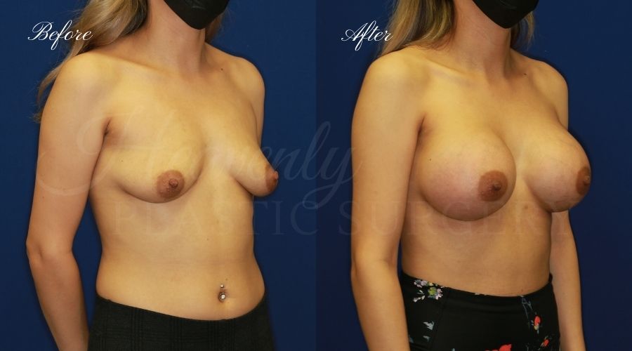 breast augmentation, breast augmentation surgery, breast augmentation surgeon, breast augmentation orange county, breast augmentation with silicone implants, sientra implants, boob job, boob job surgeon, breast implant surgeon, plastic surgery orange county, lake forest plastic surgeon, breast augmentation lake forest, south oc plastic surgeon