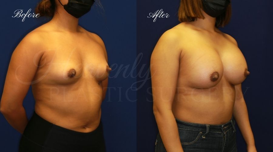 breast augmentation, breast augmentation surgery, breast augmentation surgeon, breast augmentation orange county, breast augmentation with silicone implants, sientra implants, boob job, boob job surgeon, breast implant surgeon, plastic surgery orange county, lake forest plastic surgeon, breast augmentation lake forest, south oc plastic surgeon