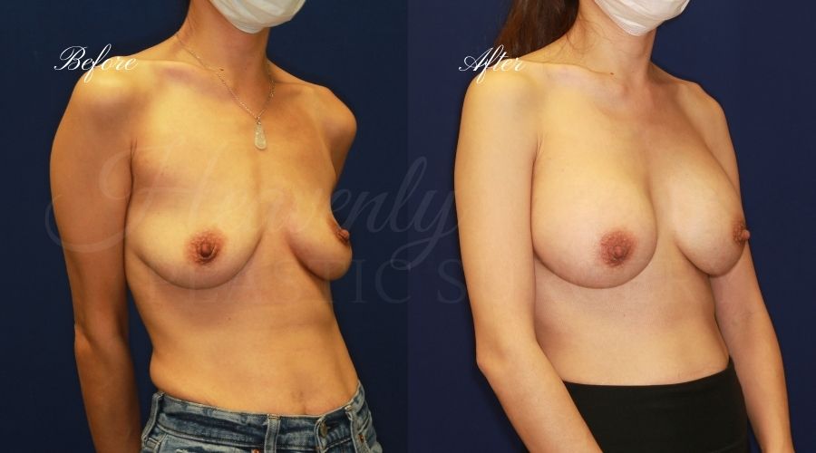 breast augmentation, breast augmentation surgery, breast augmentation surgeon, breast augmentation orange county, breast augmentation with silicone implants, sientra implants, boob job, boob job surgeon, breast implant surgeon, plastic surgery orange county, lake forest plastic surgeon, breast augmentation lake forest, south oc plastic surgeon