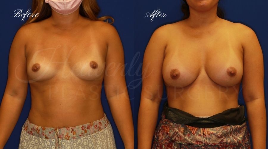 breast augmentation, breast augmentation surgery, breast augmentation surgeon, breast augmentation orange county, breast augmentation with silicone implants, sientra implants, boob job, boob job surgeon, breast implant surgeon, plastic surgery orange county, lake forest plastic surgeon, breast augmentation lake forest, south oc plastic surgeon, 300cc, 300 cc breast augmentation, breast augmentation surgery, breast augmentation surgeon, breast augmentation orange county, breast augmentation with silicone implants, sientra implants, boob job, boob job surgeon, breast implant surgeon, plastic surgery orange county, lake forest plastic surgeon, breast augmentation lake forest, south oc plastic surgeon, 300cc, 300 cc