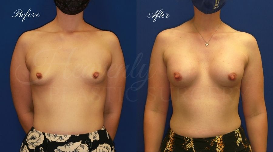 breast augmentation, breast augmentation surgery, breast augmentation surgeon, breast augmentation orange county, breast augmentation with silicone implants, sientra implants, boob job, boob job surgeon, breast implant surgeon, plastic surgery orange county, lake forest plastic surgeon, breast augmentation lake forest, south oc plastic surgeon, 350 cc, 350cc breast augmentation, breast augmentation surgery, breast augmentation surgeon, breast augmentation orange county, breast augmentation with silicone implants, sientra implants, boob job, boob job surgeon, breast implant surgeon, plastic surgery orange county, lake forest plastic surgeon, breast augmentation lake forest, south oc plastic surgeon, 350 cc, 350cc