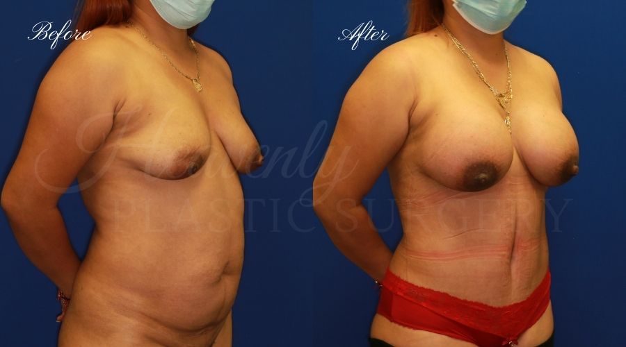 breast augmentation, breast augmentation surgery, breast augmentation surgeon, breast augmentation orange county, breast augmentation with silicone implants, sientra implants, boob job, boob job surgeon, breast implant surgeon, plastic surgery orange county, lake forest plastic surgeon, breast augmentation lake forest, south oc plastic surgeon, tummy tuck surgeon, tummy tuck, tummy tuck recovery, tummy tuck before and after, mommy makeover, mommy makeover before and after, breast augmentation and tummy tuck, 510cc, 510 cc