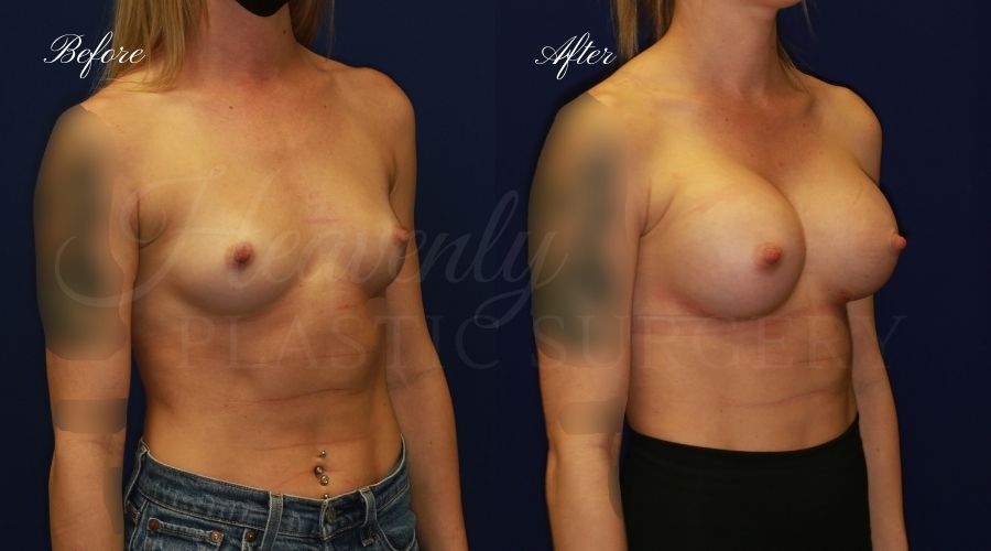 breast augmentation, breast augmentation surgery, breast augmentation surgeon, breast augmentation orange county, breast augmentation with silicone implants, sientra implants, boob job, boob job surgeon, breast implant surgeon, plastic surgery orange county, lake forest plastic surgeon, breast augmentation lake forest, south oc plastic surgeon, 470cc, 470 cc