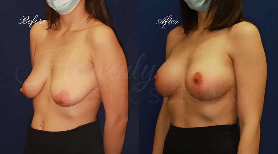 Mastopexy Augmentation (Breast Implants with Lift) - 310cc SRM Silicone breast implants with Wise-pattern breast lift (Anchor scar), plastic surgery