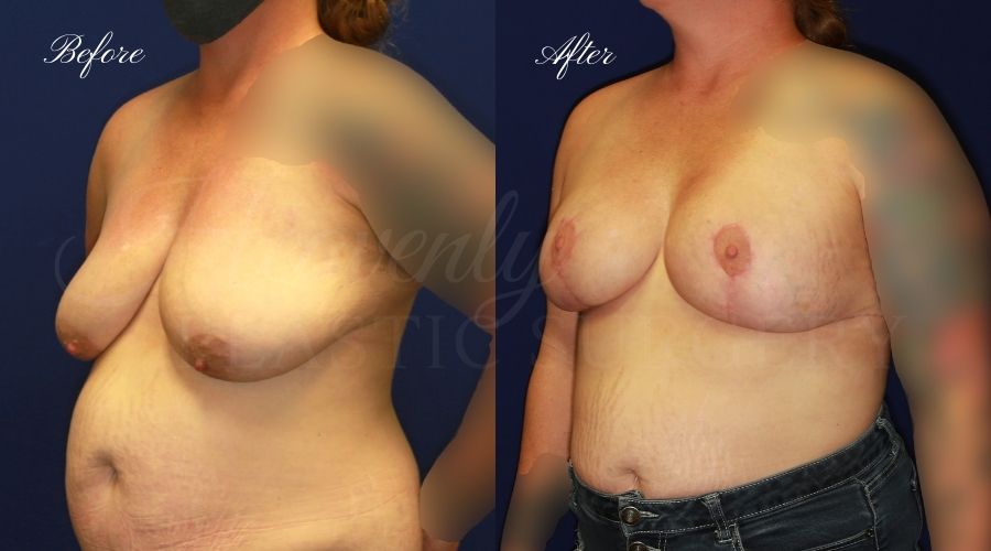 Breast lift surgery, breast lift, breast lift surgeon, mastopexy, mastopexy surgery, breast lift without implants, breast lift orange county, plastic surgery before and after, breast lift before and after, breast lift results, breast reduction, breast reduction results, plastic surgeon, plastic surgery, orange county plastic surgery, orange county plastic surgeon