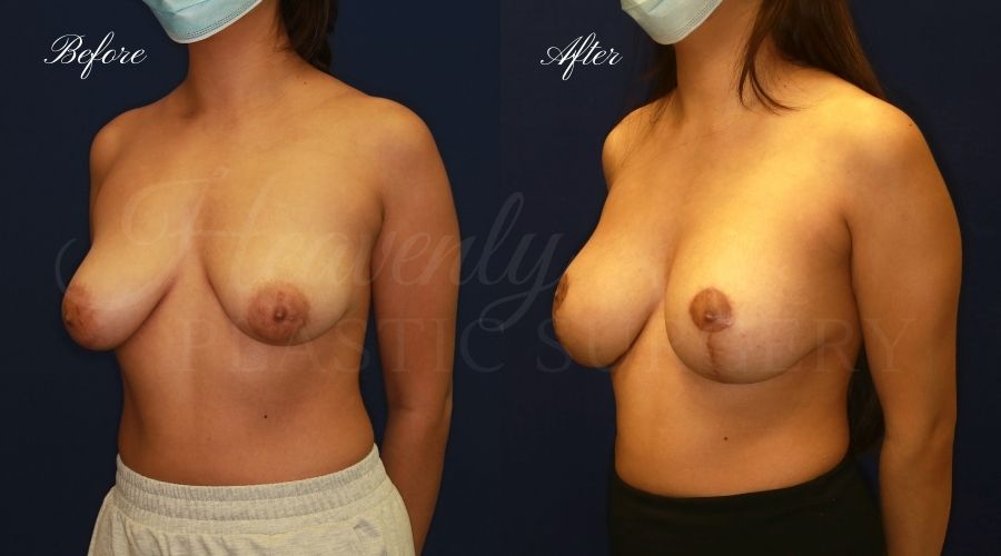 breast augmentation with breast lift, mastopexy augmentation, mastopexy augmentation surgery, breast lift surgery, breast augmentation surgery, breast lift before and after, breast lift results, breast augmentation results, breast augmentation, before and after