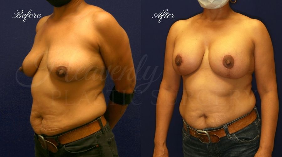 breast augmentation with breast lift, mastopexy augmentation, mastopexy augmentation surgery, breast lift surgery, breast augmentation surgery, breast lift before and after, breast lift results, breast augmentation results, breast augmentation, before and after