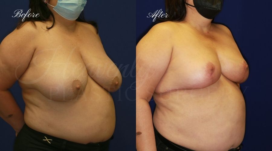 Plastic surgery, plastic surgeon, breast reduction, breast lift, reduction mammaplasty, mastopexy, before and after Plastic surgery, plastic surgeon, breast reduction, breast lift, reduction mammaplasty, mastopexy, before and after