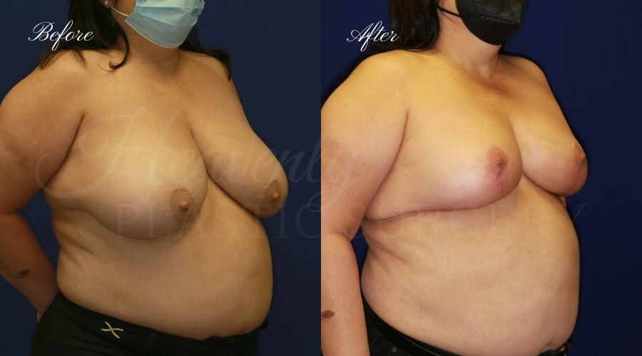 Plastic surgery, plastic surgeon, breast reduction, breast lift, reduction mammaplasty, mastopexy, before and after