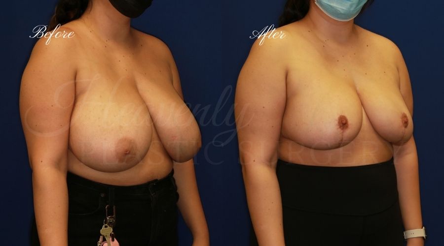 Breast Reduction Before and After, surgery, plastic surgeon, breast reduction, breast lift, reduction mammaplasty, mastopexy, before and after, mastopexy