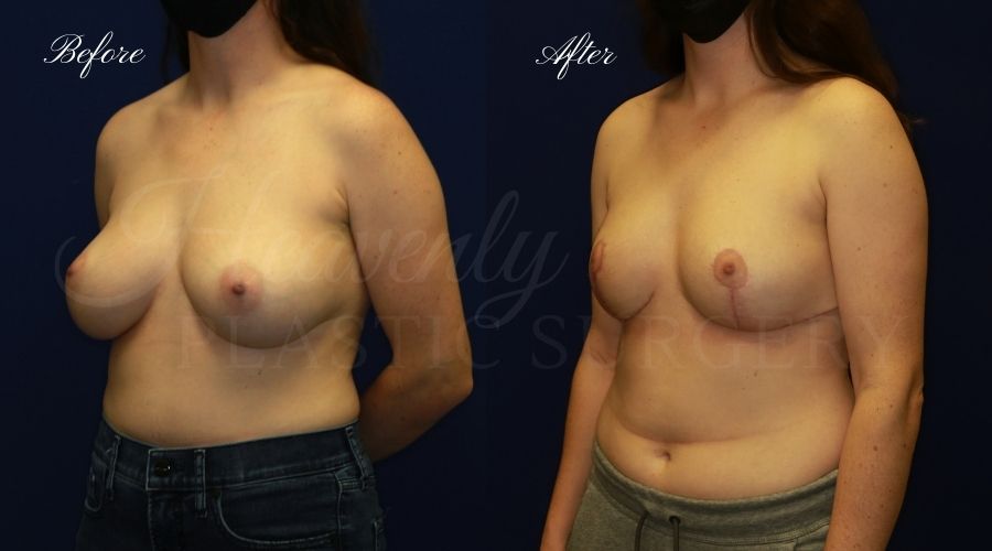 Breast lift surgery, breast lift, breast lift surgeon, mastopexy, mastopexy surgery, breast lift without implants, breast lift orange county, plastic surgery before and after, breast lift before and after, breast lift results, breast reduction, breast reduction results, plastic surgeon, plastic surgery, orange county plastic surgery, orange county plastic surgeon