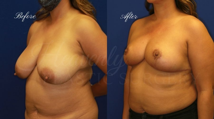 Breast lift surgery, breast lift, breast lift surgeon, mastopexy, mastopexy surgery, breast lift without implants, breast lift orange county, plastic surgery before and after, breast lift before and after, breast lift results, breast reduction, breast reduction results, plastic surgeon, plastic surgery, orange county plastic surgery, orange county plastic surgeon