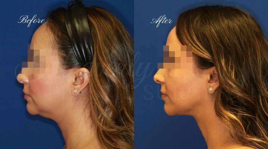 Chin liposuction, liposuction before and after, chin liposuction before and after, chin lipo, jawline surgery, jawline procedure, jawline before and after, chin before and after, plastic surgery before and after, chin liposuction surgeon, liposuction surgeon, plastic surgeon, face surgeon, plastic surgery orange county, chin liposuction orange county, chin lipo orange county, liposuction orange county, medspa orange county, plastic surgery orange county, best plastic surgeon orange county, lake forest plastic surgery, face plastic surgery, face before and after, plastic surgery check