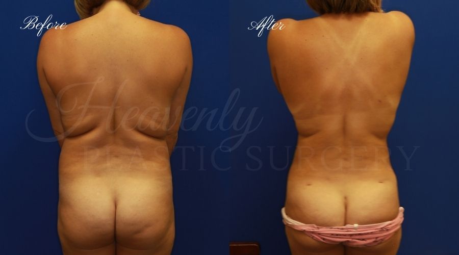 explant, breast implant removal, breast implant revision, breast implant removal and breast lift, breast lift, breast correction, liposuction, liposuction 360, lipoetching, breast implant surgeon, breast implant revision surgeon, breast implants orange county, liposuction orange county, liposuction orange county, back liposuction, lipoetching, contour