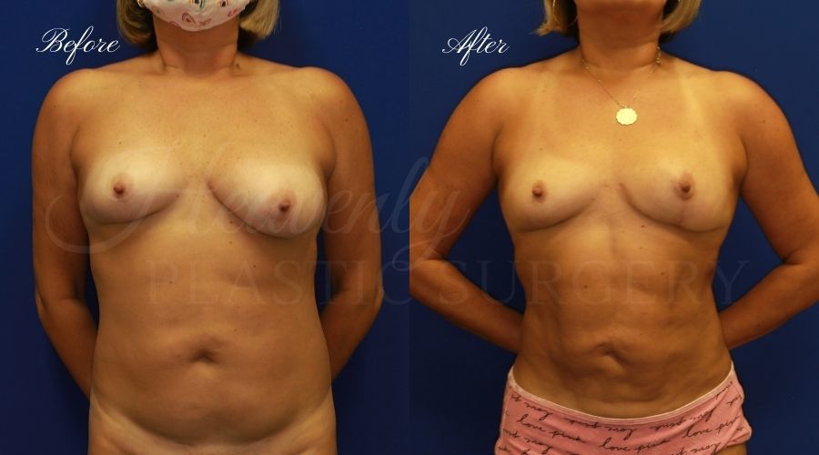 explant, breast implant removal, breast implant revision, breast implant removal and breast lift, breast lift, breast correction, liposuction, liposuction 360, lipoetching, breast implant surgeon, breast implant revision surgeon, breast implants orange county, liposuction orange county, liposuction orange county, back liposuction, lipoetching, contour