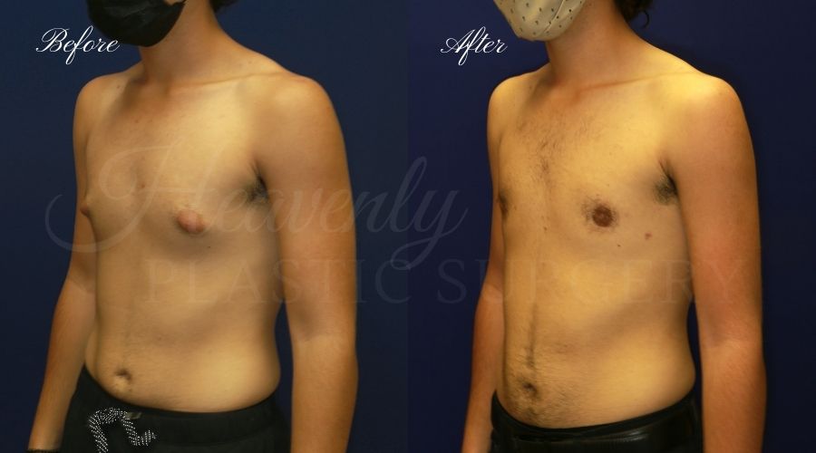 gynecomastia before and after, gynecomastia treatment, gynecomastia results, gynecomastia excision, gynecomastia surgeon, gynecomastia orange county, moobs, man boobs, man boob surgery, male breast tissue, male breast tissue surgery, plastic surgery before and after, plastic surgeon, orange county plastic surgeon, orange county plastic surgery gynecomastia before and after, gynecomastia treatment, gynecomastia results, gynecomastia excision, gynecomastia surgeon, gynecomastia orange county, moobs, man boobs, man boob surgery, male breast tissue, male breast tissue surgery, plastic surgery before and after, plastic surgeon, orange county plastic surgeon, orange county plastic surgery