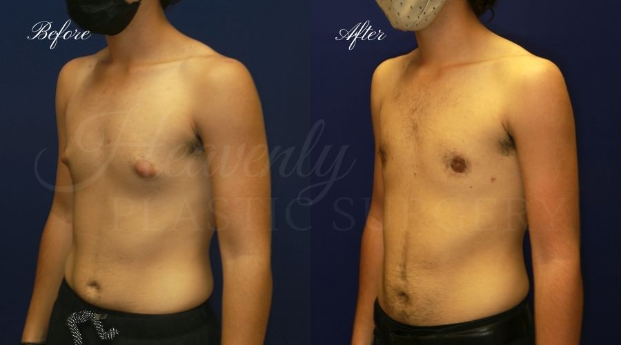 gynecomastia before and after, gynecomastia treatment, gynecomastia results, gynecomastia excision, gynecomastia surgeon, gynecomastia orange county, moobs, man boobs, man boob surgery, male breast tissue, male breast tissue surgery, plastic surgery before and after, plastic surgeon, orange county plastic surgeon, orange county plastic surgery