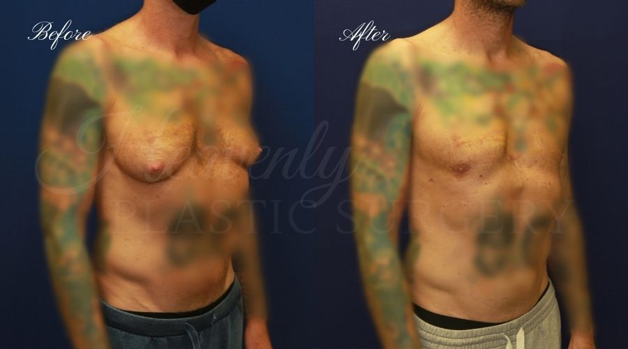 gynecomastia before and after, gynecomastia treatment, gynecomastia results, gynecomastia excision, gynecomastia surgeon, gynecomastia orange county, moobs, man boobs, man boob surgery, male breast tissue, male breast tissue surgery, plastic surgery before and after, plastic surgeon, orange county plastic surgeon, orange county plastic surgery