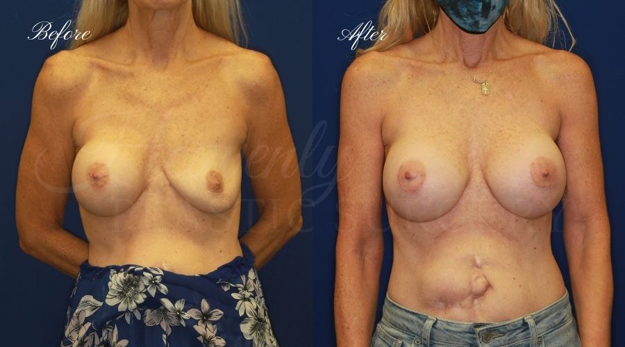 Breast Implant Exchange and Breast Lift - 310cc SRM Silicone Implants with Wise pattern Mastopexy (Anchor Scar)