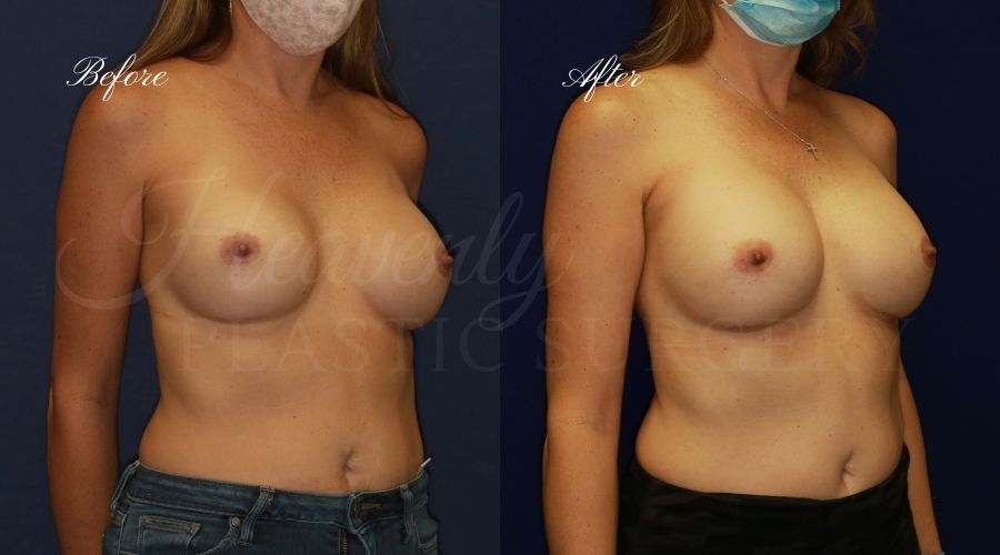 Plastic surgery, plastic surgeon, breast surgery, breast implant revision, deflated breast implant, breast augmentation correction, implant exchange, breast implants, implant exchange, breast implant exchange