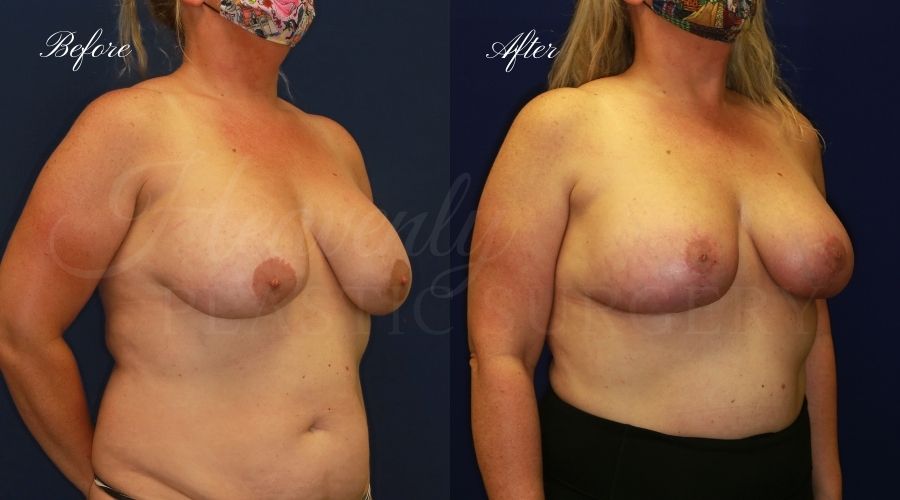 Breast Implant Exchange and Breast Lift - 310cc SRM Silicone Implants with Wise pattern Mastopexy (Anchor Scar)