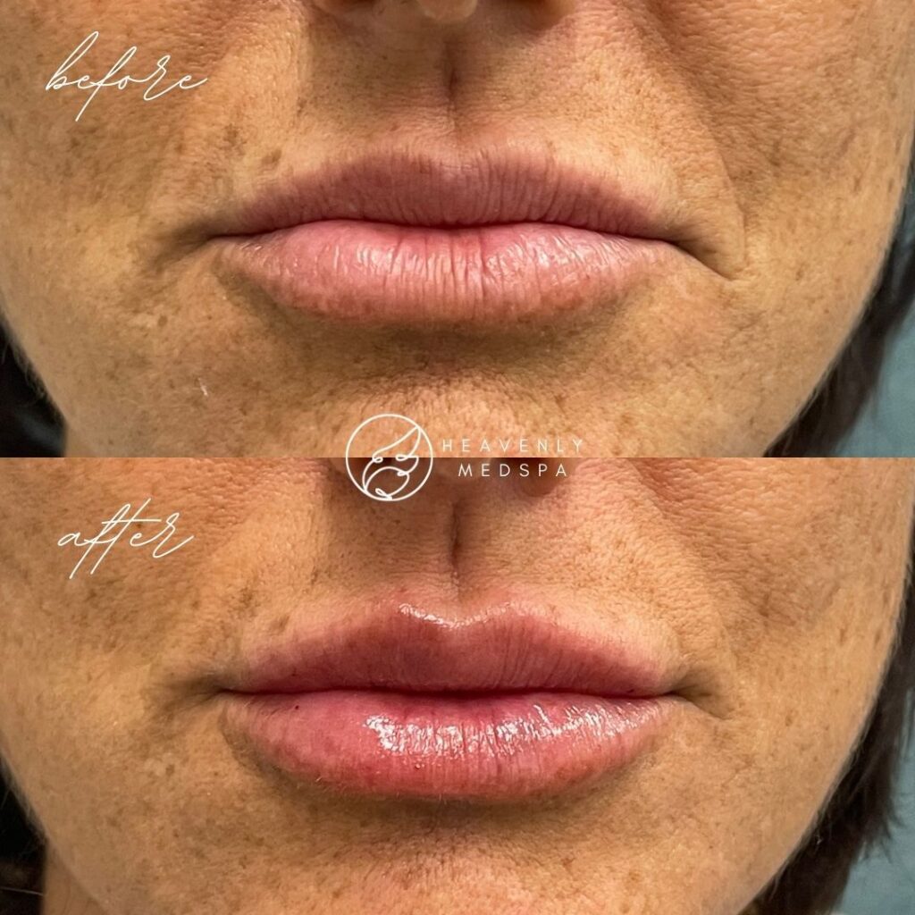 lip filler, dermal filler, lip filler orange county, lip filler foothill ranch, lip filler lake forest, nurse injector, medspa, medspa lake forest, lip filler medspa, lip filler before and after, revanesse versa, versa before and after, lip filler before and after