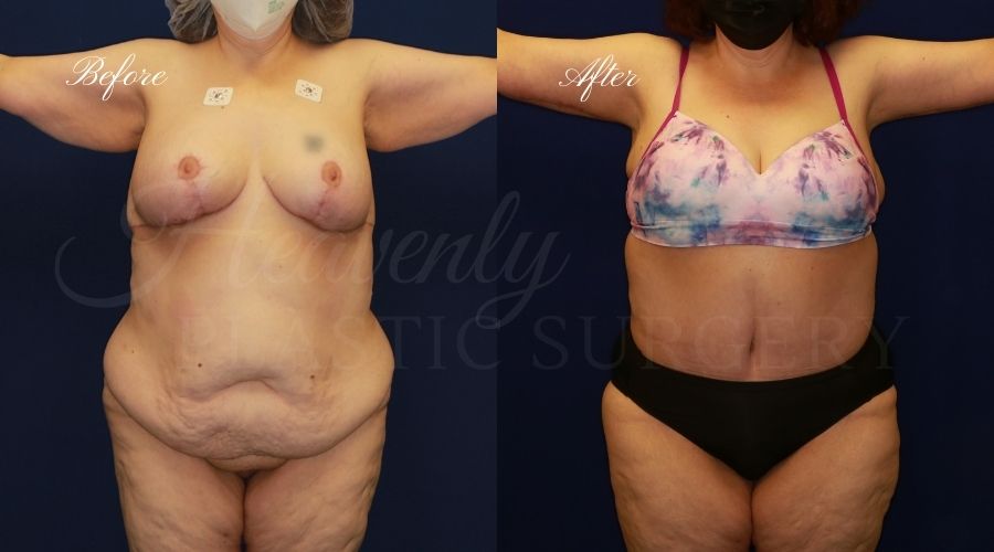 Mommy Makeover - Arm Lift + Tummy Tuck Before and After, Mommy makeover orange county, mommy makeover surgeon, mommy makeover orange county