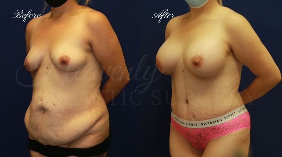 Mommy Makeover - Implant Exchange + Tummy Tuck Before and After, Mommy Makeover Orange County, Mommy Makeover Surgeon, Mommy Makeover Surgery