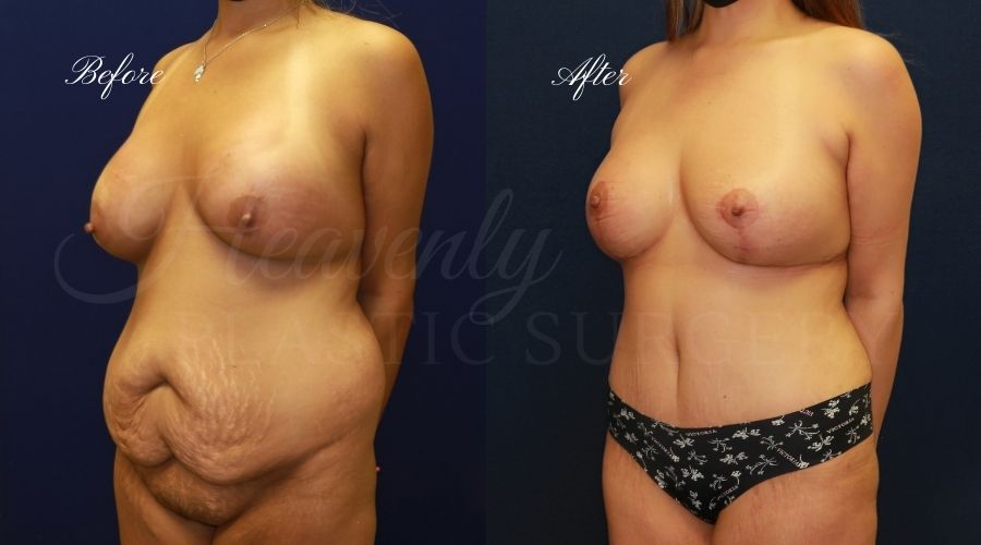 Mommy makeover before and after, mommy makeover surgery, breast lift surgery, tummy tuck surgery, breast lift before and after, tummy tuck before and after, mommy makeover surgeon, mommy makeover surgery, mommy makeover orange county, tummy tuck orange county, breast lift orange county, plastic surgery, plastic surgeon, plastic surgery before and after, mommy makeover journey, mommy makeover results, tummy tuck journey, tummy tuck results, plastic surgery results, orange county plastic surgeon, orange county plastic surgery, plastic surgery orange county Mommy makeover before and after, mommy makeover surgery, breast lift surgery, tummy tuck surgery, breast lift before and after, tummy tuck before and after, mommy makeover surgeon, mommy makeover surgery, mommy makeover orange county, tummy tuck orange county, breast lift orange county, plastic surgery, plastic surgeon, plastic surgery before and after, mommy makeover journey, mommy makeover results, tummy tuck journey, tummy tuck results, plastic surgery results, orange county plastic surgeon, orange county plastic surgery, plastic surgery orange county