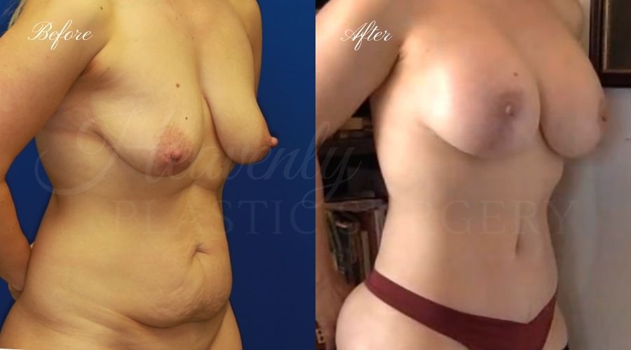 Mommy makeover before and after, mommy makeover surgery, breast lift surgery, tummy tuck surgery, breast lift before and after, tummy tuck before and after, mommy makeover surgeon, mommy makeover surgery, mommy makeover orange county, tummy tuck orange county, breast lift orange county, plastic surgery, plastic surgeon, plastic surgery before and after, mommy makeover journey, mommy makeover results, tummy tuck journey, tummy tuck results, plastic surgery results, orange county plastic surgeon, orange county plastic surgery, plastic surgery orange county Mommy makeover before and after, mommy makeover surgery, breast lift surgery, tummy tuck surgery, breast lift before and after, tummy tuck before and after, mommy makeover surgeon, mommy makeover surgery, mommy makeover orange county, tummy tuck orange county, breast lift orange county, plastic surgery, plastic surgeon, plastic surgery before and after, mommy makeover journey, mommy makeover results, tummy tuck journey, tummy tuck results, plastic surgery results, orange county plastic surgeon, orange county plastic surgery, plastic surgery orange county