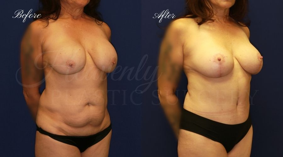 Mommy makeover before and after, mommy makeover surgery, breast augmentation surgery, tummy tuck surgery, breast augmentation before and after, tummy tuck before and after, mommy makeover surgeon, mommy makeover surgery, mommy makeover orange county, tummy tuck orange county, breast augmentationorange county, plastic surgery, plastic surgeon, plastic surgery before and after, mommy makeover journey, mommy makeover results, tummy tuck journey, tummy tuck results, plastic surgery results, orange county plastic surgeon, orange county plastic surgery, plastic surgery orange county, breast implants, breast implants orange county Mommy makeover before and after, mommy makeover surgery, breast augmentation surgery, tummy tuck surgery, breast augmentation before and after, tummy tuck before and after, mommy makeover surgeon, mommy makeover surgery, mommy makeover orange county, tummy tuck orange county, breast augmentationorange county, plastic surgery, plastic surgeon, plastic surgery before and after, mommy makeover journey, mommy makeover results, tummy tuck journey, tummy tuck results, plastic surgery results, orange county plastic surgeon, orange county plastic surgery, plastic surgery orange county, breast implants, breast implants orange county