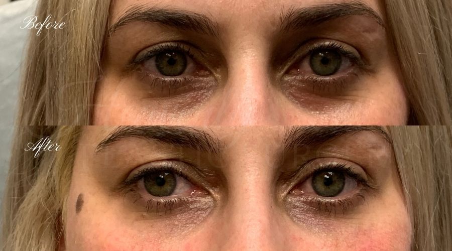 Tear trough filler, undereye filler, eye filler, dermal filler, nurse injector, medspa, filler medspa, filler orange county, under eye filler orange county, filler orange county Tear trough filler, undereye filler, eye filler, dermal filler, nurse injector, medspa, filler medspa, filler orange county, under eye filler orange county, filler orange county