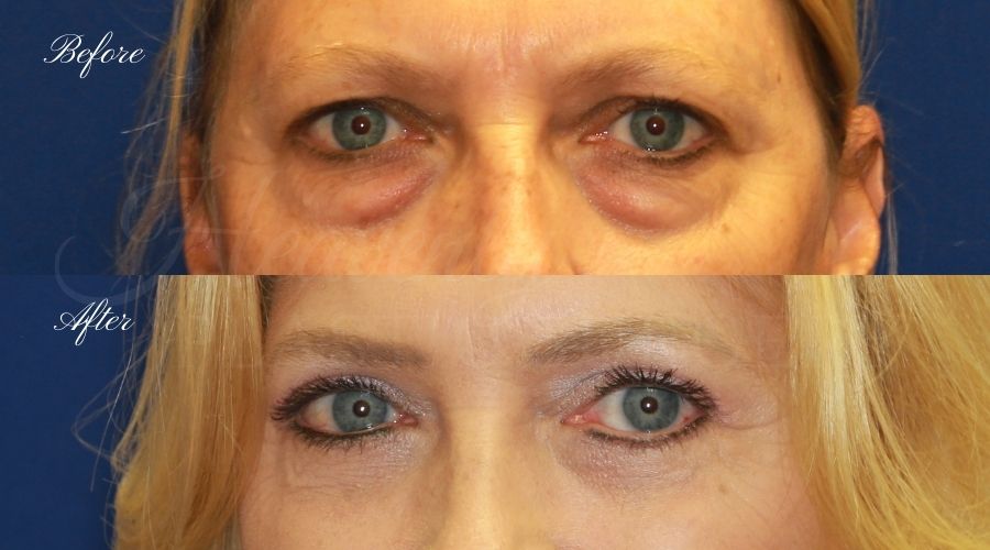 Plastic surgeon, plastic surgery, upper blepharoplasty, eyelid surgery